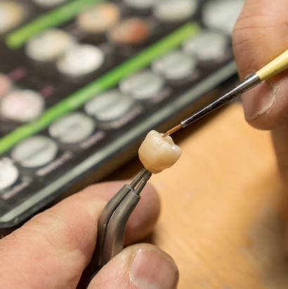 Protesi dentale realizzata in laboratorio odontotecnico
